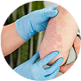 Psoriasis/Eczema